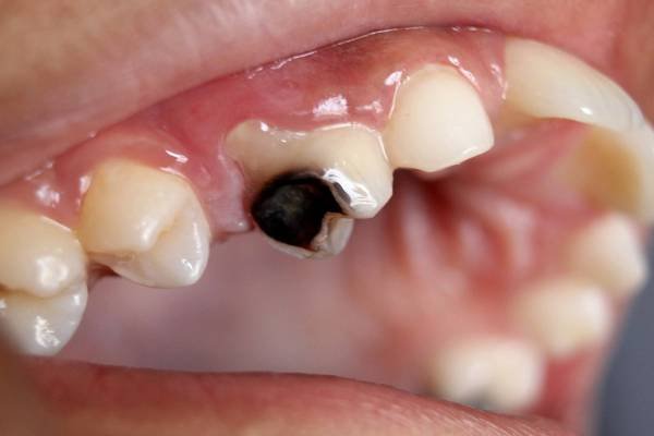 Tooth Decay