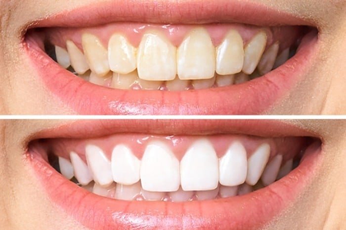 Darkening of Teeth.