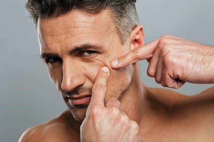 Consequences of Squeezing Facial Pimples