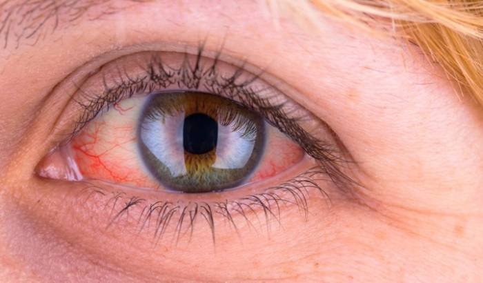 RP retinal disease