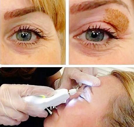 Plexr Nose Treatment Duration