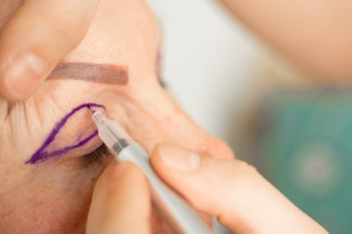 Post-blepharoplasty measures