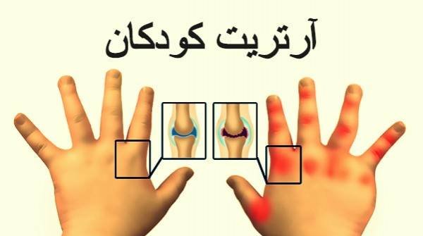Arthritis and Joint Pain in Children