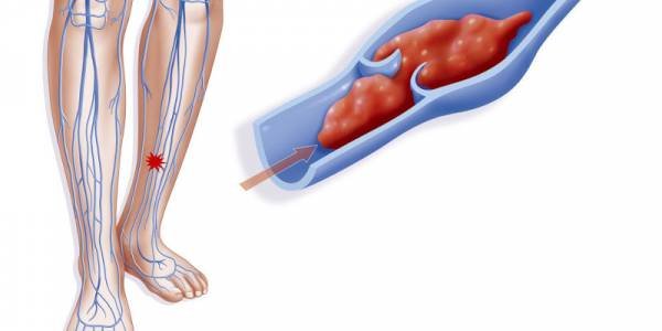Causes of DVT leg disease