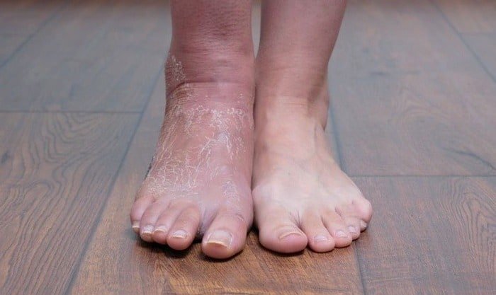Reasons for leg swelling