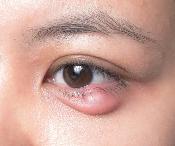Eye infection