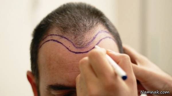 From A to Z of Hair Transplantation and Grafting Hair Transplantation and Grafting