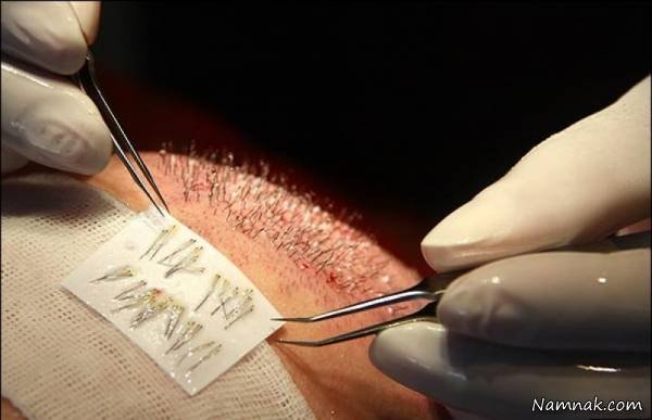 Which Hair Transplant Method is More Suitable for You? Method of Hair Transplantation
