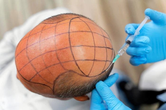👈 Baldness is no longer optional! | Hair Loss Treatment (Free Consultation)