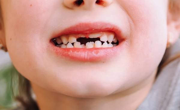 The Importance of Baby Teeth