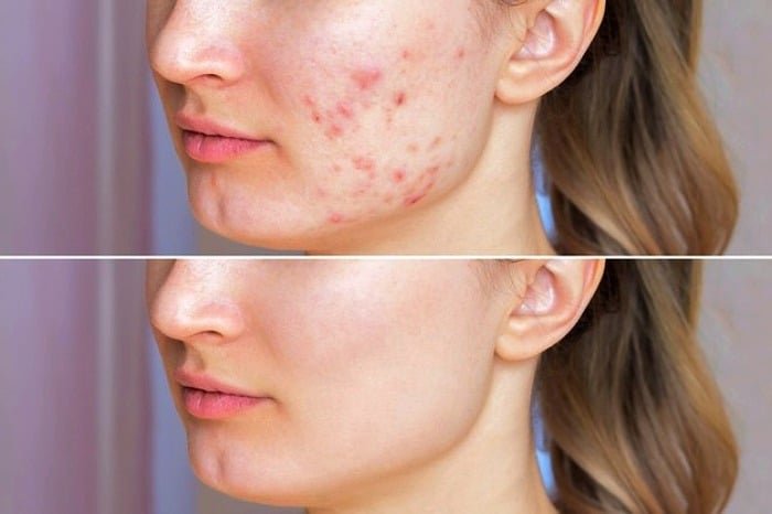 Fading scars with Persian clay