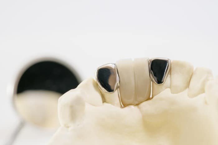 Filling Teeth with Amalgam