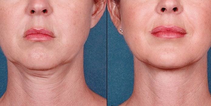 Side effects of RF on the skin