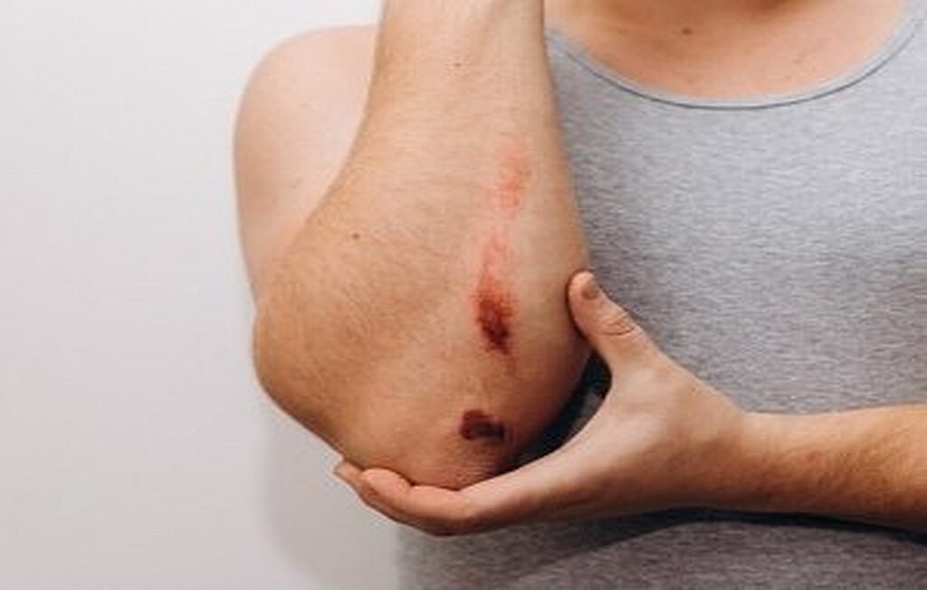 Causes, Symptoms, and Home Remedies for Wound Infections + Nutrition and Prevention