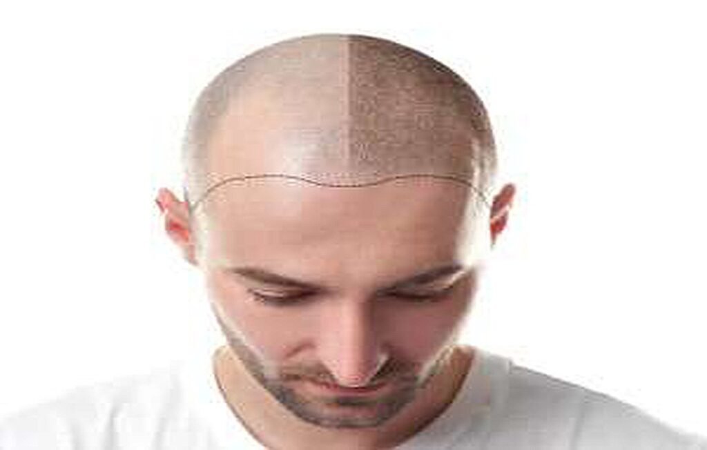 Latest and Best Methods for Hair Transplantation