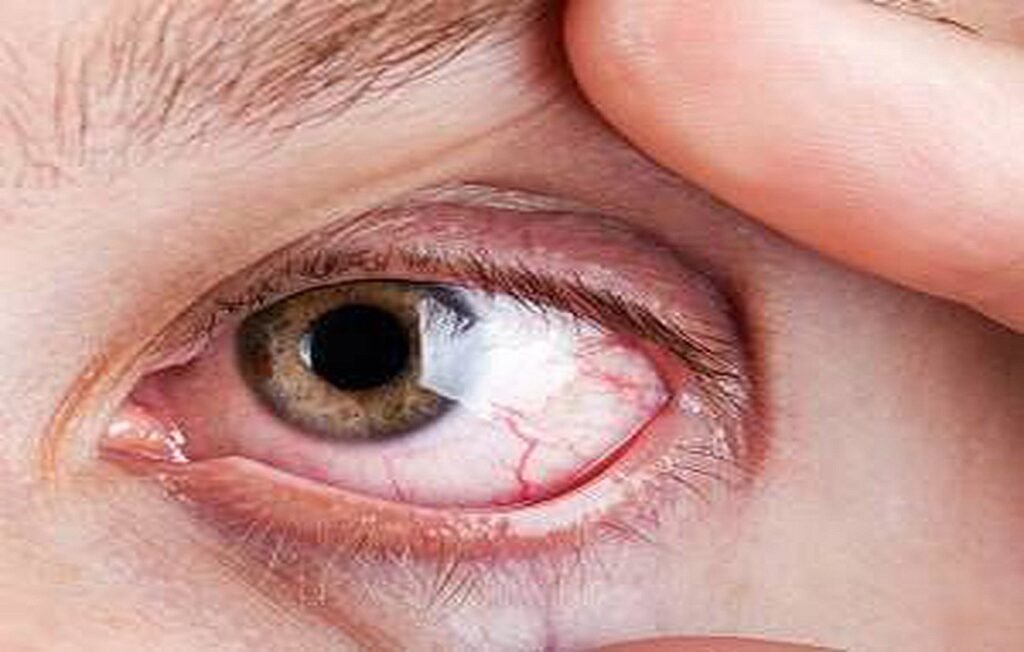 Causes and Symptoms of RP Disease + Efforts for Treatment