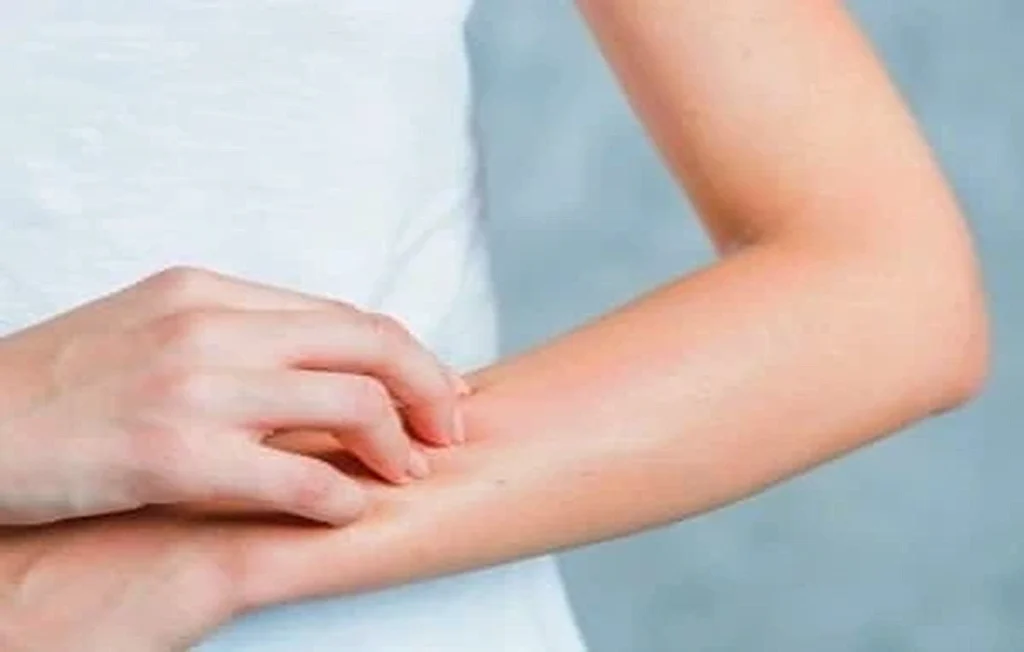 Stress and Eczema Connection + Reasons for Flare-Ups