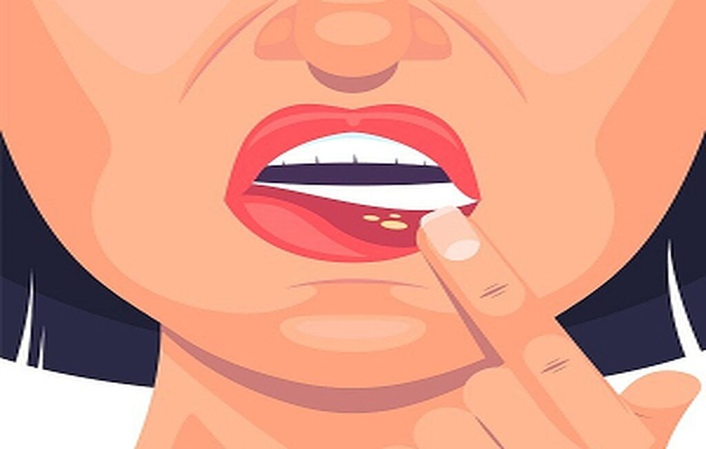 Difference Between Mouth Ulcers and Oral Warts